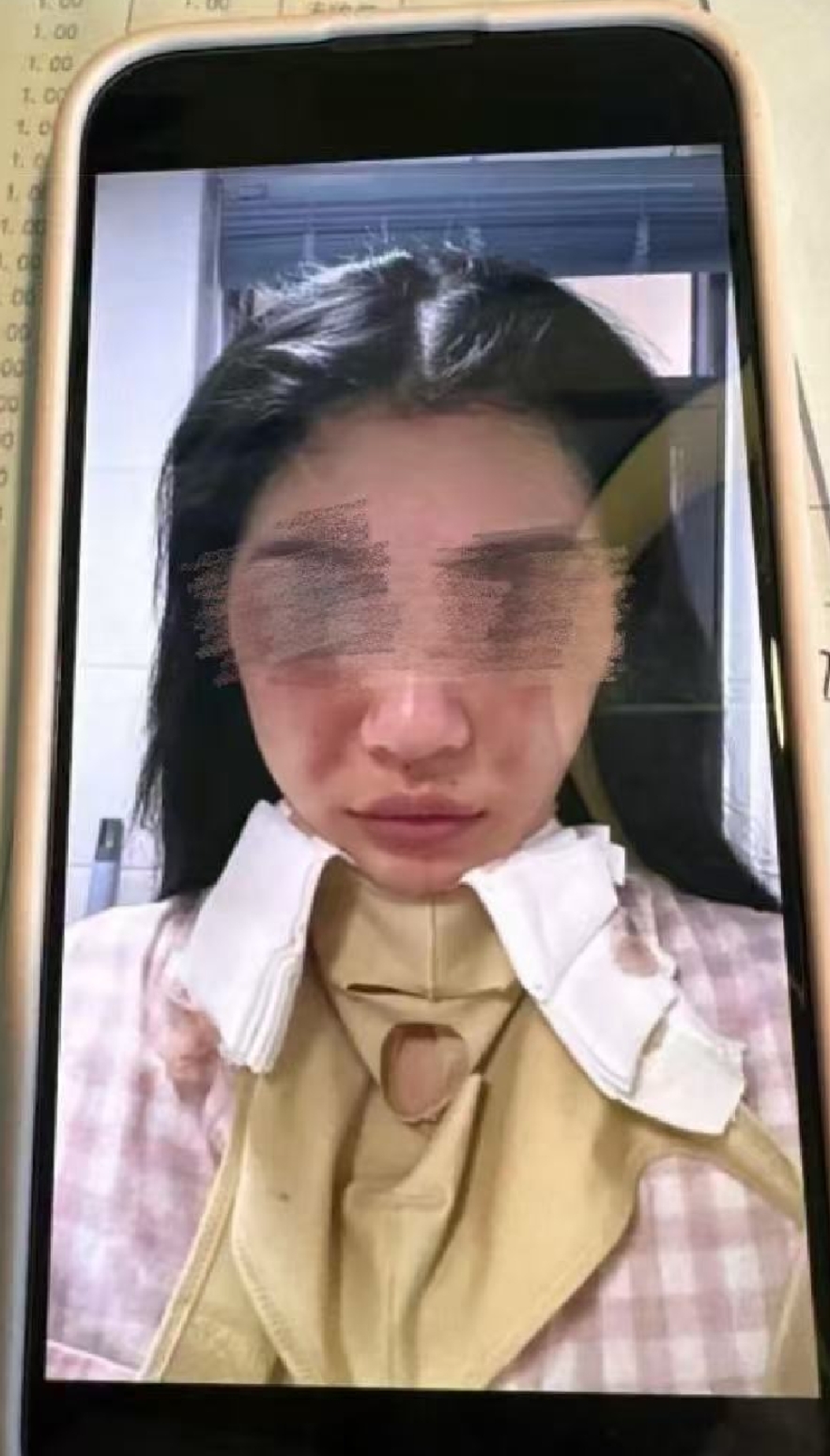 美容致毁容抑郁,花季少女被忽悠至郑州悦容整形医院造成身心创伤